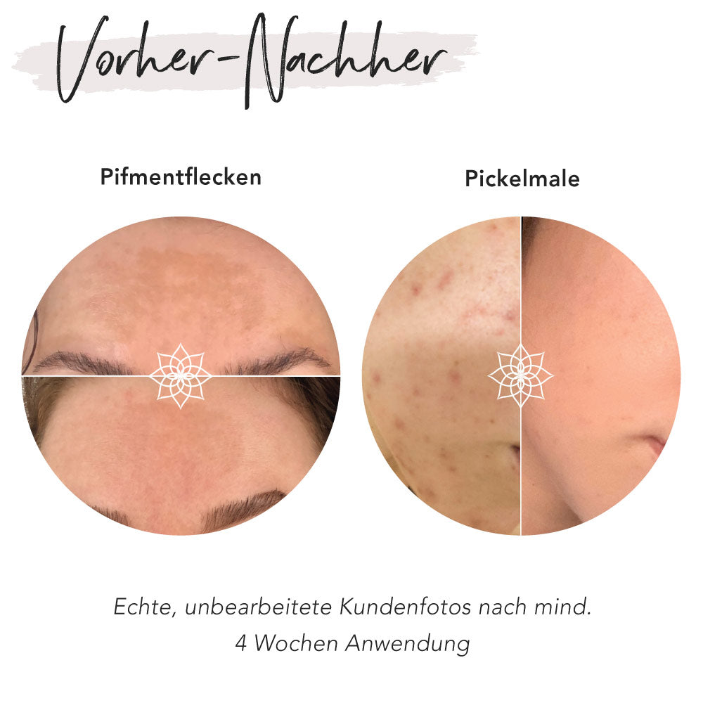 Pigment Control Microneedling System