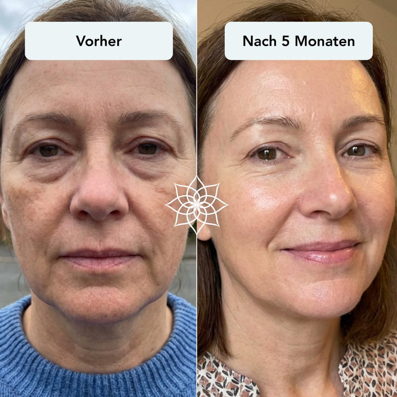 Erschlaffte Haut & Falten