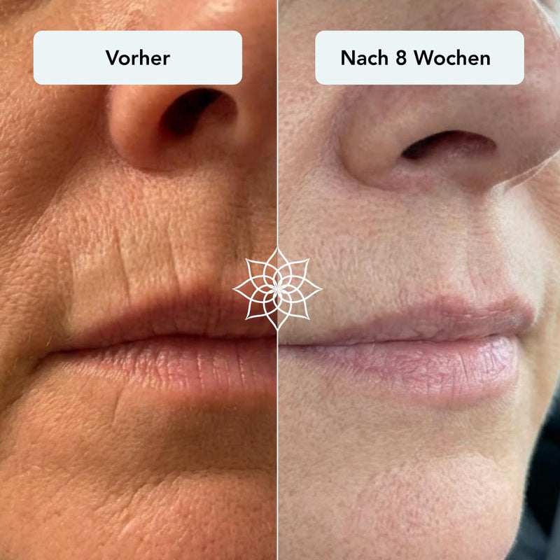 251126_Anti-Aging-Microneedling_Vorher-Nachher_Mundfalten-rauchen.jpg__PID:f3aa0a81-5e29-4519-b018-1dc6d120f7c2