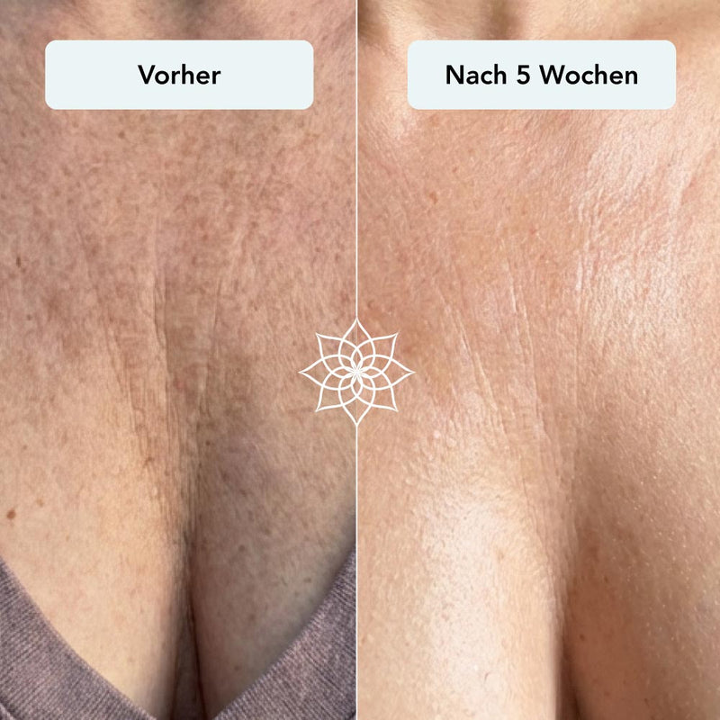 251126_Anti-Aging-Microneedling_Vorher-Nachher_decollete.jpg__PID:257f5c5b-202d-465b-8ec5-09b33c8c19d7