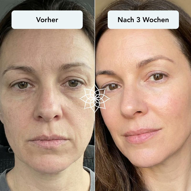 251126_Anti-Aging-Microneedling_Vorher-Nachher_falten-schlaffe-haut.jpg__PID:8dae49a6-29a0-4ddf-a0a0-3765e6b8c535