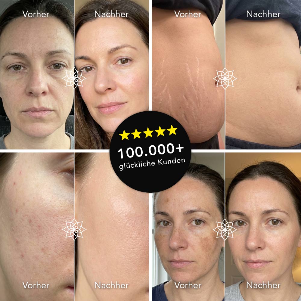 Microneedling Spar Bundle