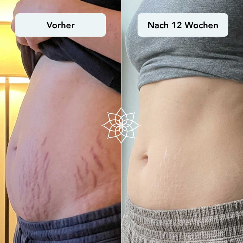 Vergrößerte Poren