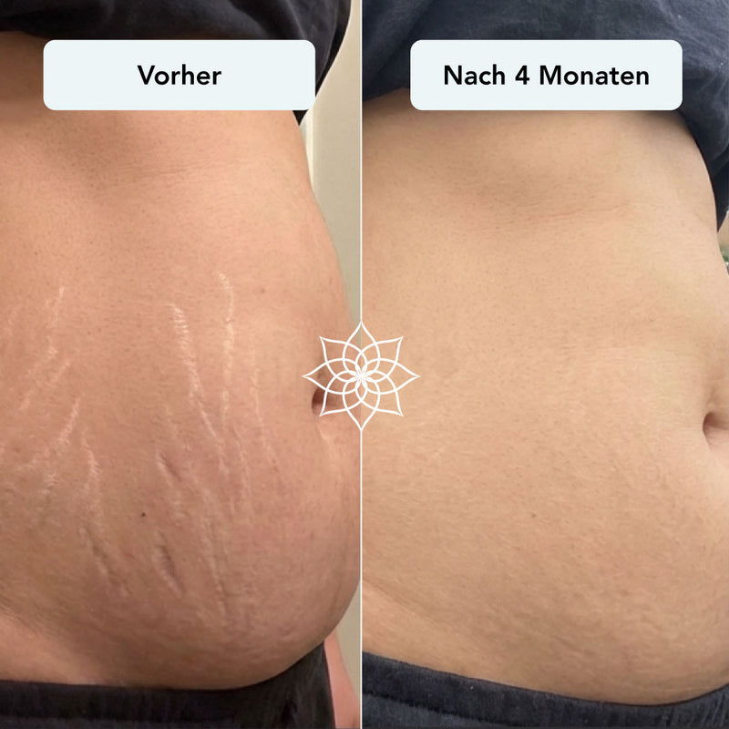 260115_Listingbilder_Body-Microneedling-System_Dehnungsstreifen-hell.jpg__PID:61dca513-0077-46ac-ad74-be84446a56f6