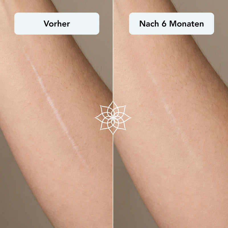 260115_Listingbilder_Body-Microneedling-System_narben.jpg__PID:dca51300-7736-4c2d-b4be-84446a56f615