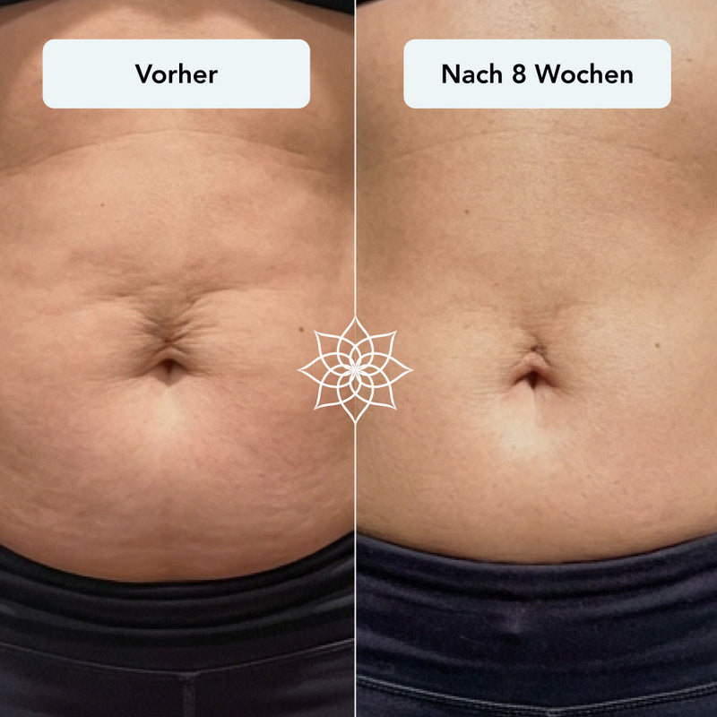 260115_Listingbilder_Body-Microneedling-System_schlaffe-Haut-post-partum.jpg__PID:007736ac-2d74-4e84-846a-56f61583d8df