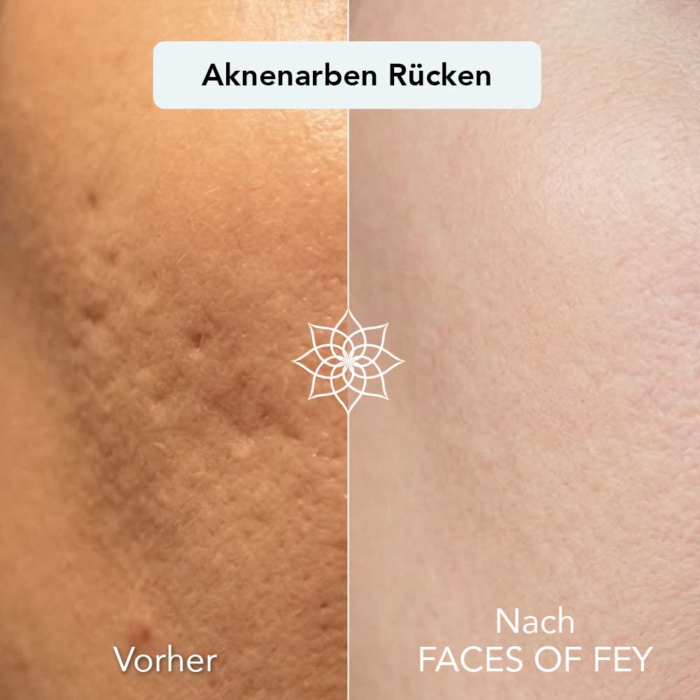 Body Renewal Microneedling System