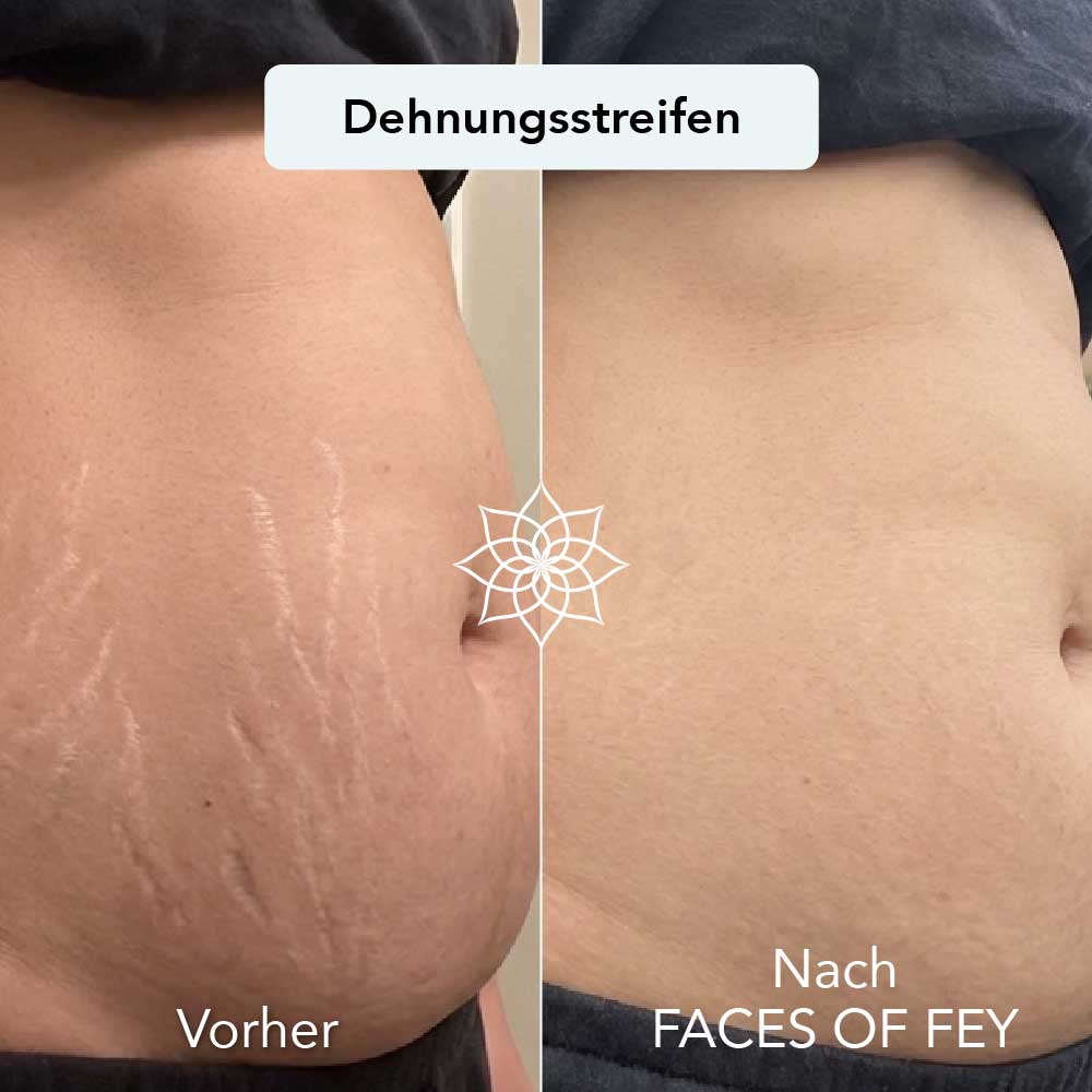 Body Renewal Microneedling System