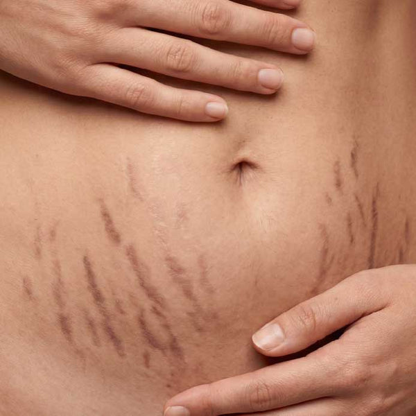 Cellulite & Dehnungsstreifen