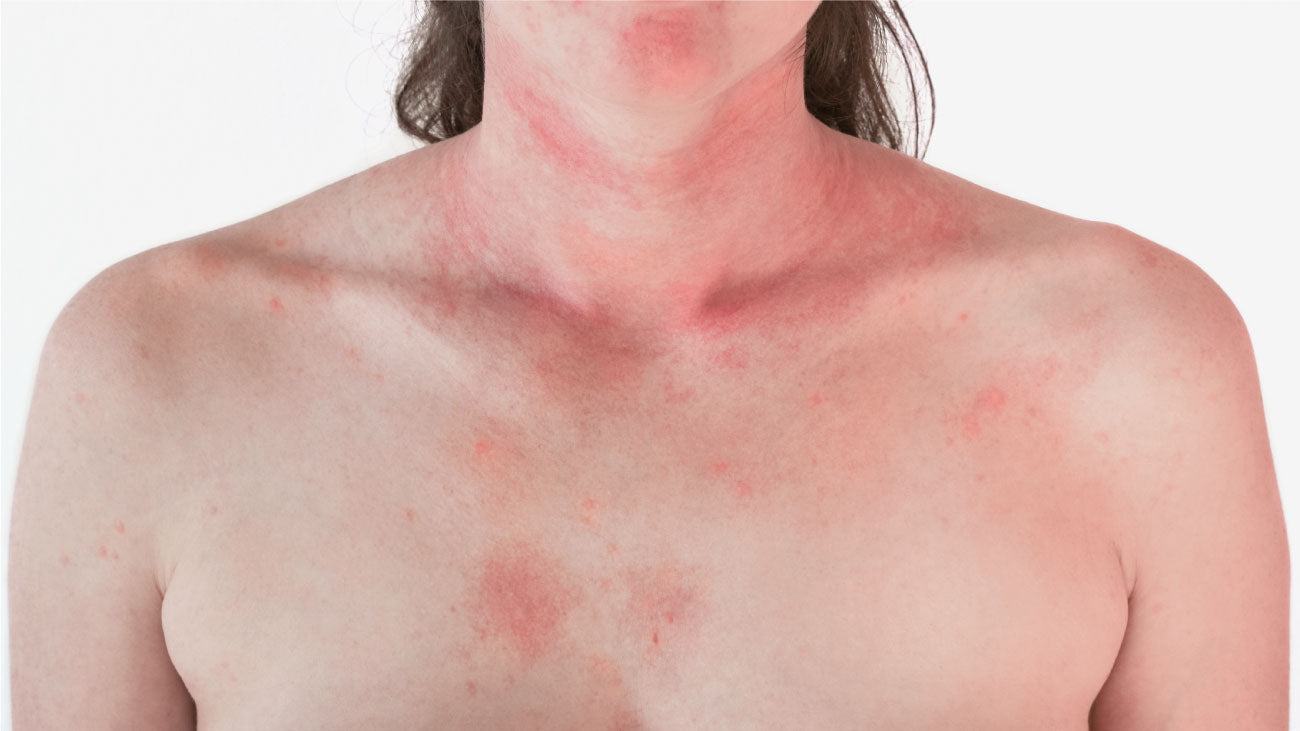 allergische-reaktion-haut.jpg__PID:5cc78d81-66ea-4bf6-a534-8f1880a8bb4d