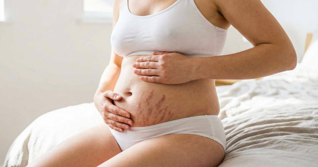 Microneedling gegen Dehnungsstreifen