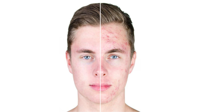 Erstverschlimmerung Skin Purging