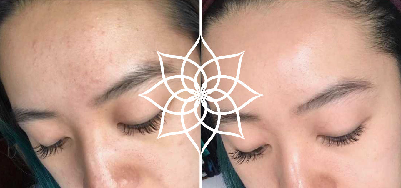 Fungal Akne vorher nachher