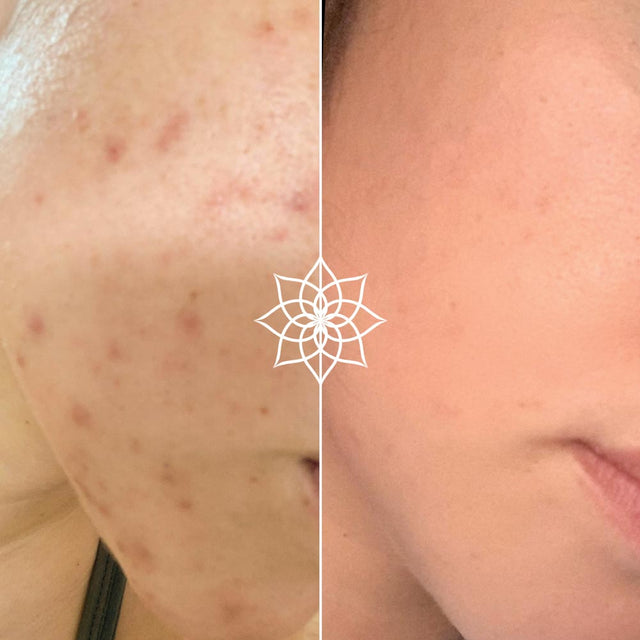 Microneedling Vorher-Nachher Ergebnisse