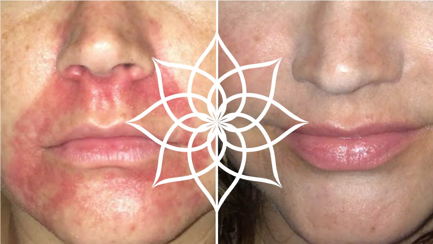 Periorale Dermatitis