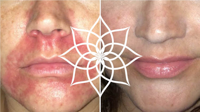 Periorale Dermatitis