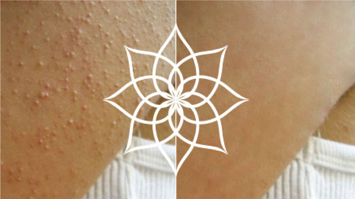 Reibeisenhaut, Keratosis Pilaris