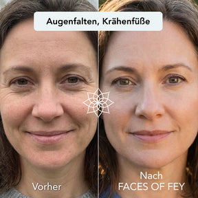 Anti-Aging Microneedling System