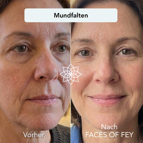 Anti-Aging Microneedling System