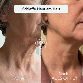 Anti-Aging Microneedling System