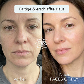 Anti-Aging Microneedling System