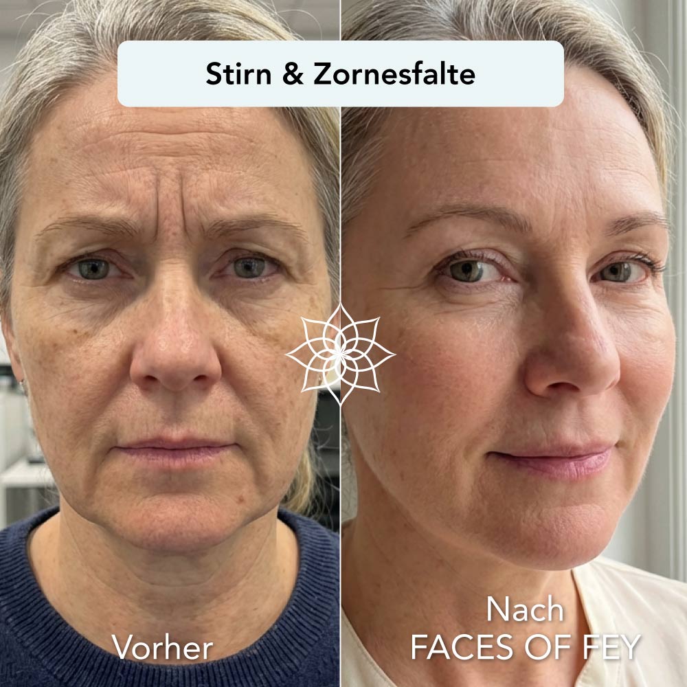 Anti-Aging Microneedling System