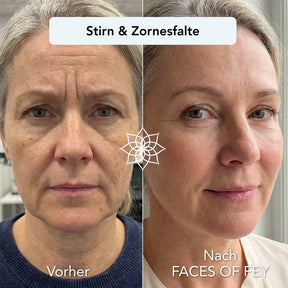 Anti-Aging Microneedling System