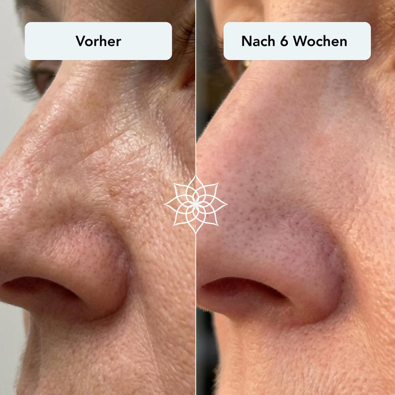 251126_Anti-Aging-Microneedling_Vorher-Nachher_nase.jpg__PID:7a70e12e-55fe-42e3-a816-36b53cd98286