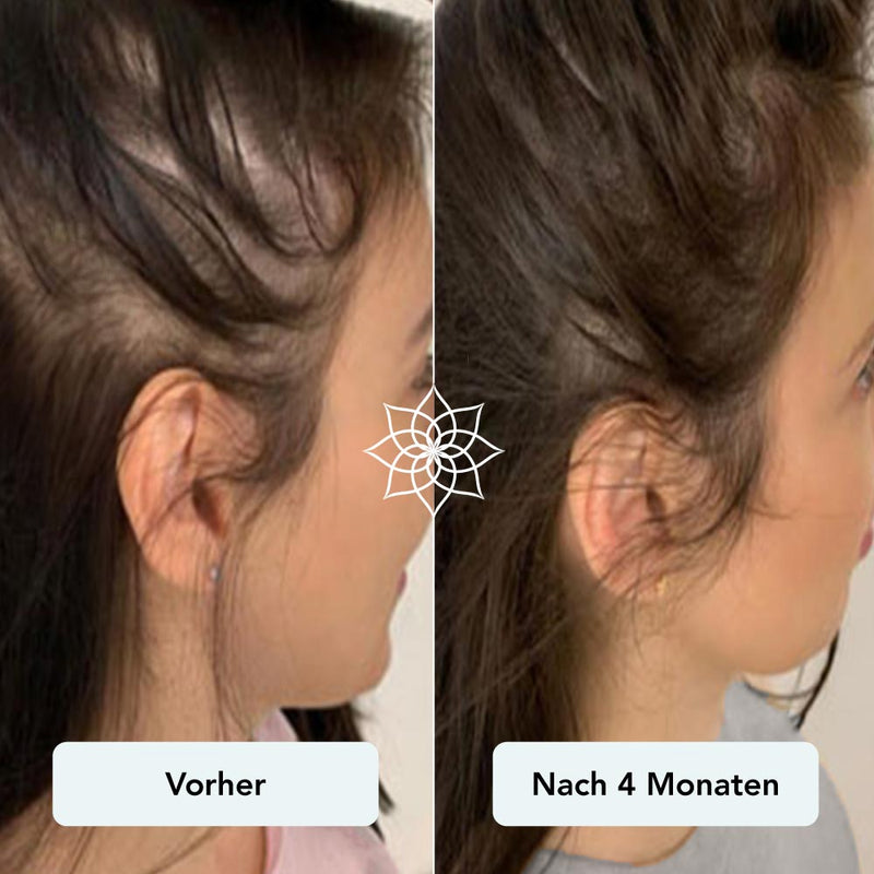 Diffuser Haarausfall