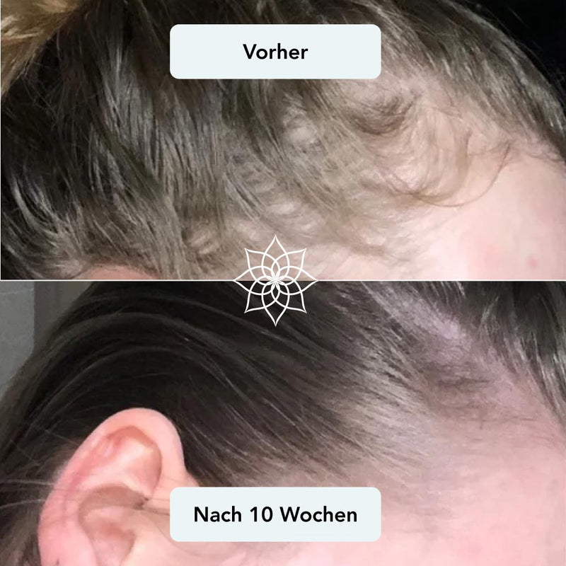 Geheimratsecken & seitlicher Haaransatz