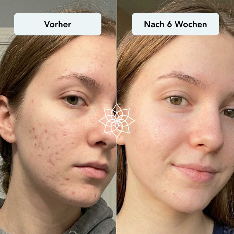 Pickelmale & Aknenarben