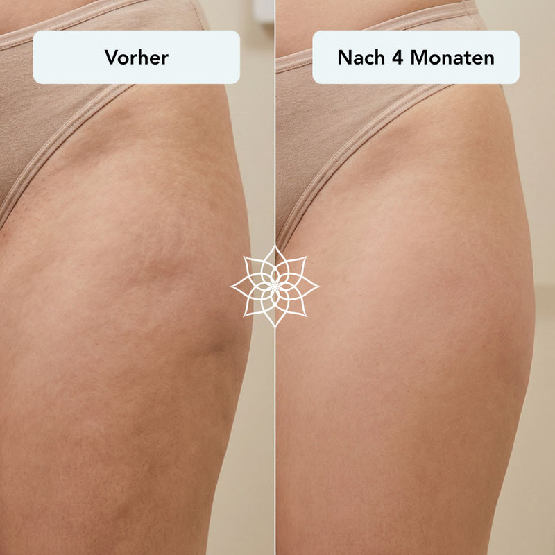 260115_Listingbilder_Body-Microneedling-System_cellulite-bein.jpg__PID:d7462464-61dc-4513-8077-36ac2d74be84