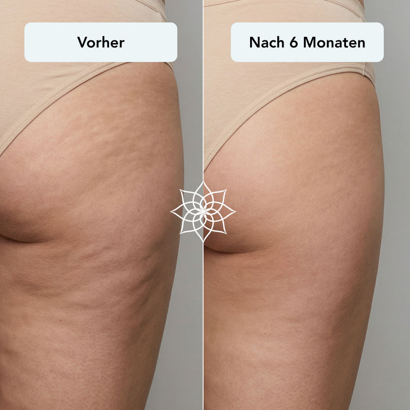 260115_Listingbilder_Body-Microneedling-System_cellulite-po.jpg__PID:46246461-dca5-4300-b736-ac2d74be8444