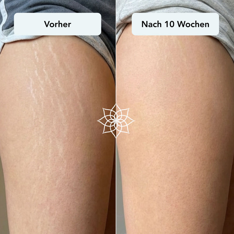 260115_Listingbilder_Body-Microneedling-System_dehnungsstreifen-bein.jpg__PID:246461dc-a513-4077-b6ac-2d74be84446a