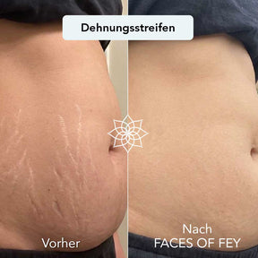 Body Renewal Microneedling System