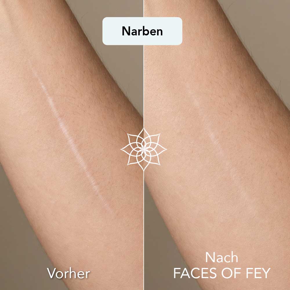 Body Renewal Microneedling System