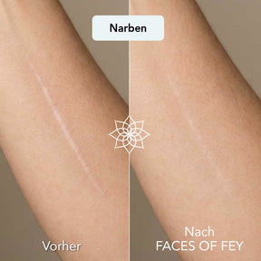 Body Renewal Microneedling System