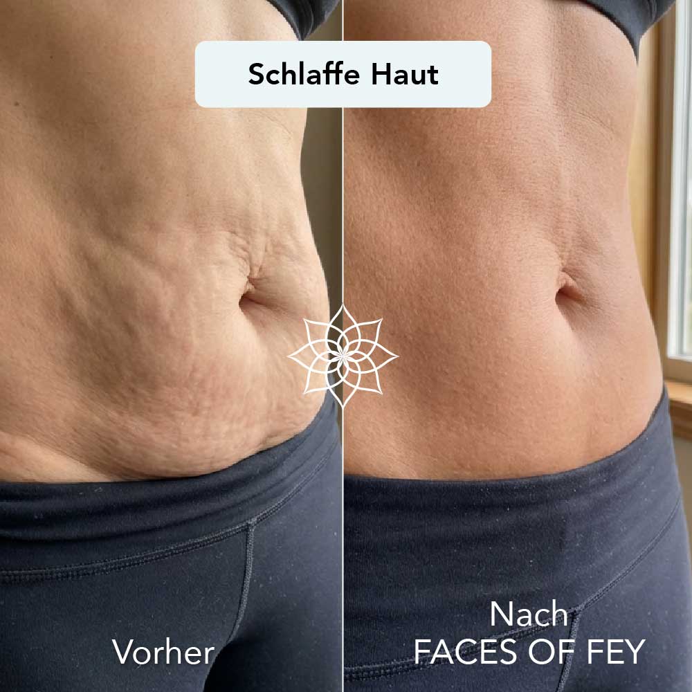 Body Renewal Microneedling System