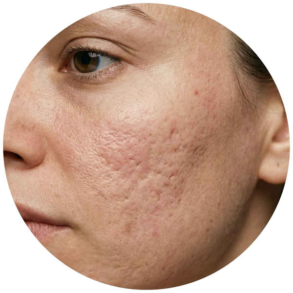 Aknenarben & unebenes Hautbild 
