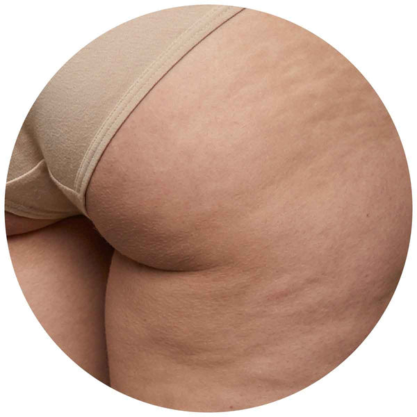 Cellulite & Orangenhaut 