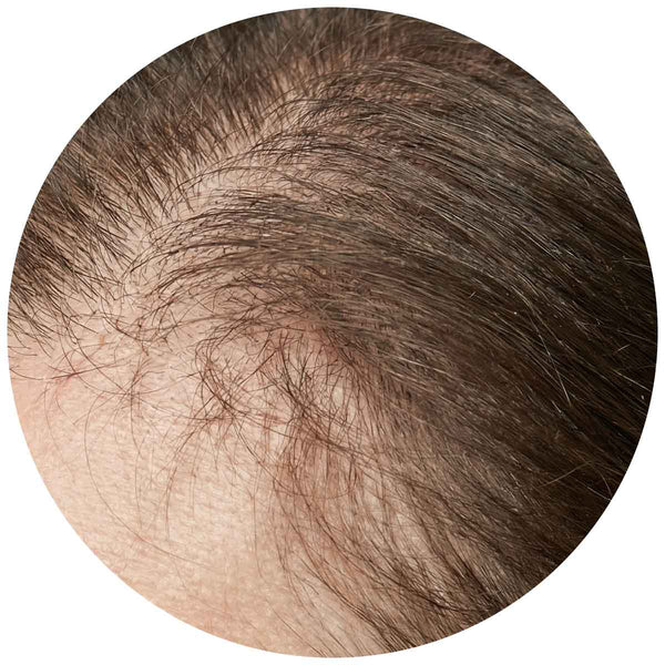 Haarausfall & dünner werdendes Haar 