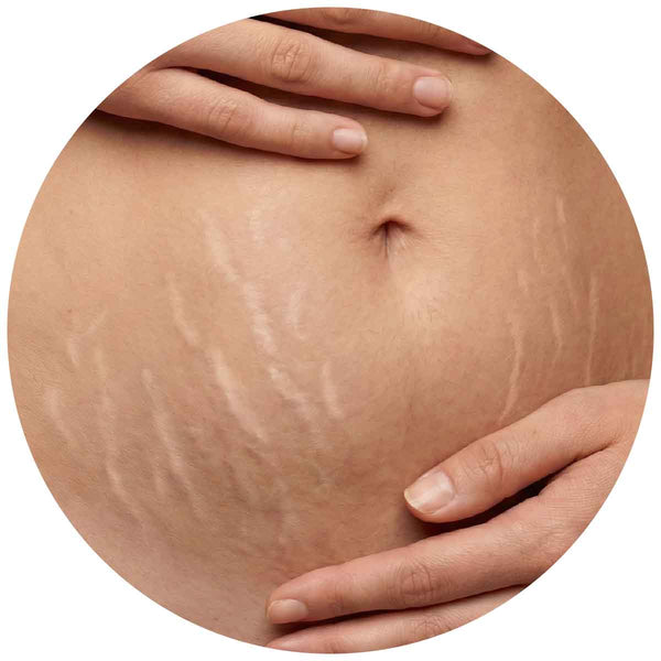 Dehnungsstreifen & Narbengewebe 