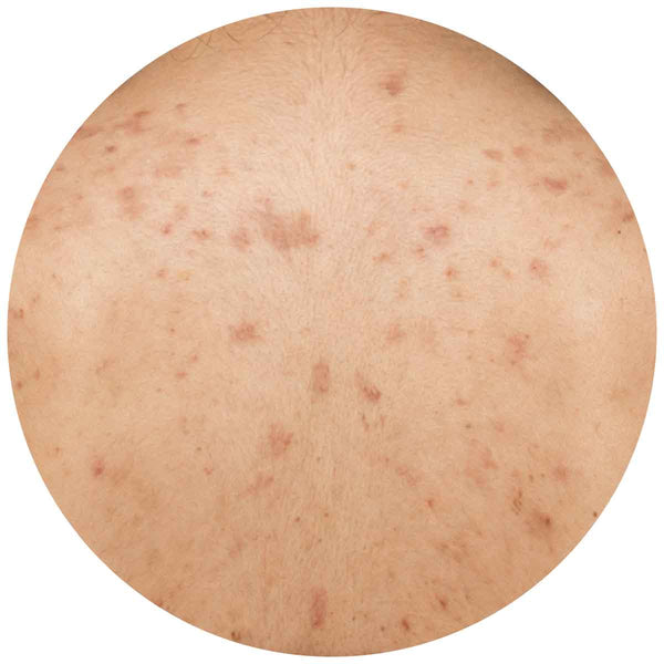 Pigmentflecken & ungleichmaessiger Teint 