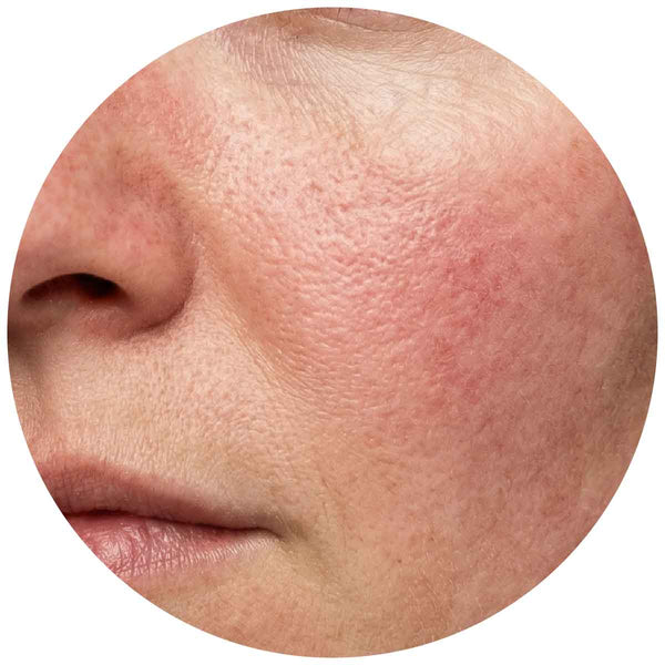 Rötungen & empfindliche Haut