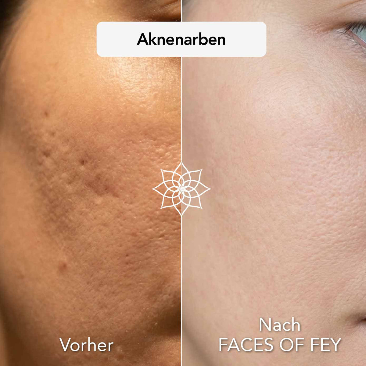 Blemish Control Microneedling System