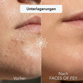 Blemish Control Microneedling System