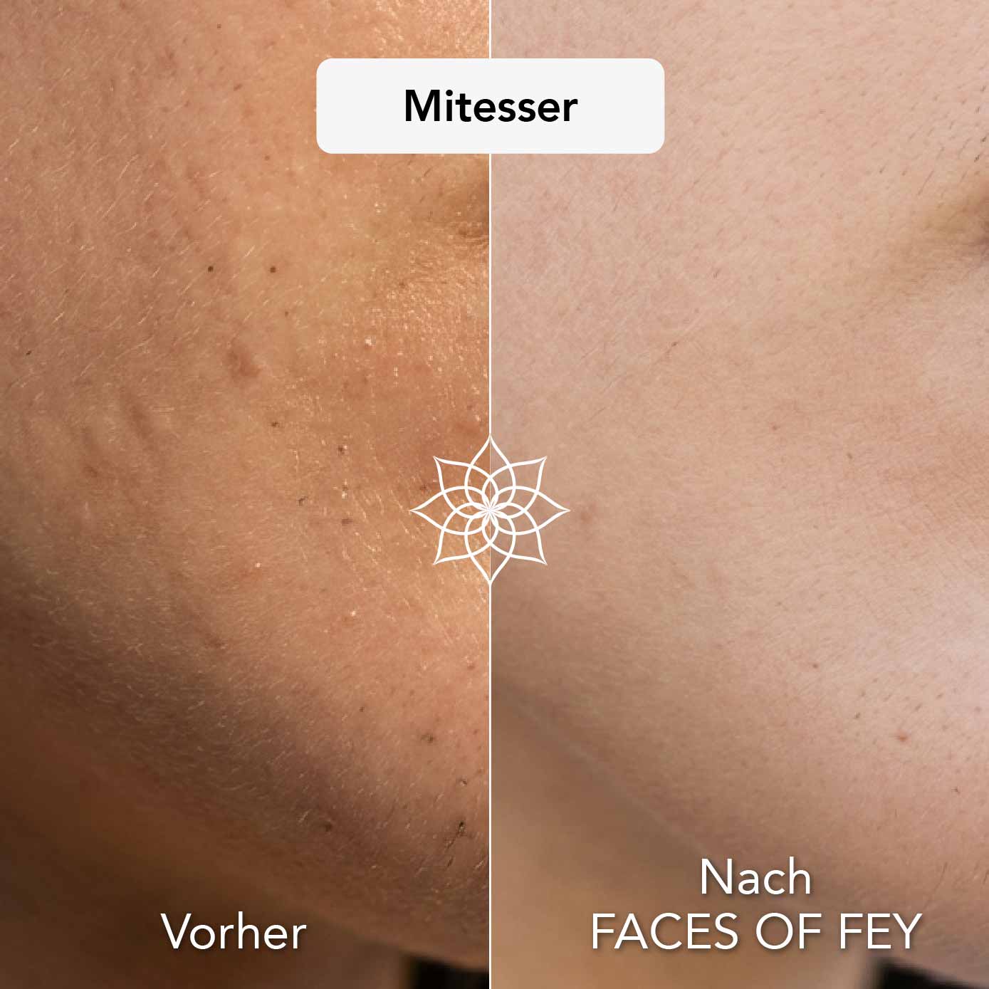 Blemish Control Microneedling System