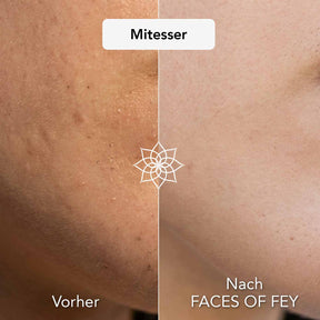 Blemish Control Microneedling System