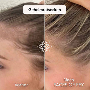 Hair Growth Microneedling System