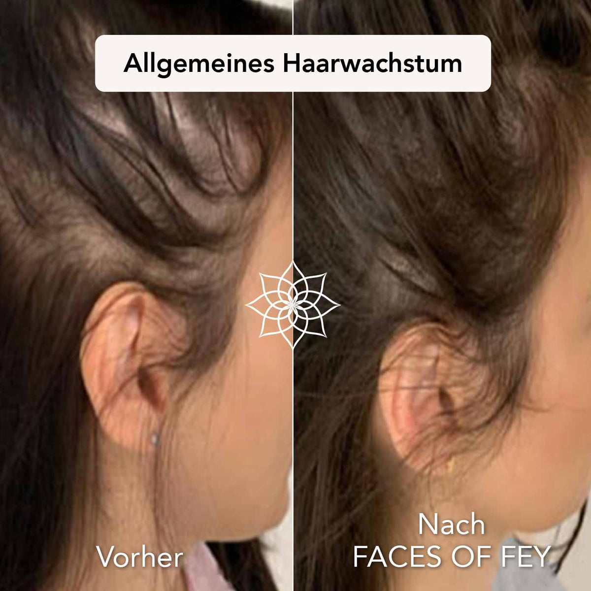 Hair Growth Microneedling System